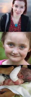 Efficacy and Safety of SD-101 Cream in Patients with Epidermolysis Bullosa:  Results From a Phase 2b Study Paller A1, Browning J