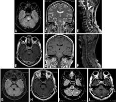 Lecture in internal medicine for iv course students. Clippers Syndrome Responsive To Leflunomide A Case Report Multiple Sclerosis And Related Disorders