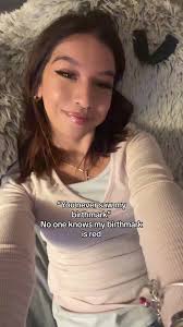 Red Birthmark Shai Moss