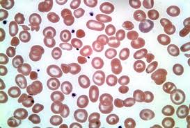 Maybe you would like to learn more about one of these? Alpha Thalassemia Symptoms Diagnosis And Treatment Bmj Best Practice Us