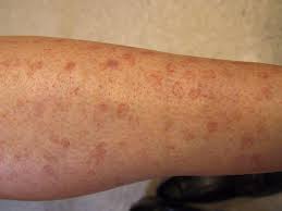 Image result for liver spots on legs