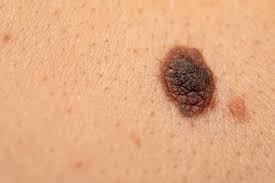 Some types of skin cancer are more dangerous than others, but if you have a spot. Skin Cancer Diagnosis Apps Are Unreliable And Poorly Regulated Study Shows Nursingnotes
