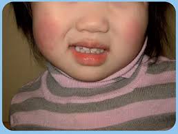 Full article: Characterizing Viral Exanthems