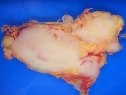 Lymphoma is a general term for cancers that start in the lymph system (the tissues and organs that produce, store, and carry white blood cells that fight infections). Lymphoma Wikipedia