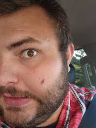 If you notice a scar