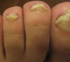 Image result for mykoza nehtů