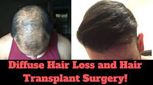 This chapter discusses conditions that can cause diffuse hair loss. Can You Have A Hair Transplant With Diffuse Hair Loss Youtube