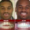 Most dental insurance plans cover clear aligners just as they would cover regular braces, but check with your insurance company and ask them about the extent of their coverage. 1