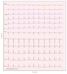 Maybe you would like to learn more about one of these? Ecg Interpretation Characteristics Of The Normal Ecg P Wave Qrs Complex St Segment T Wave Ecg Echo