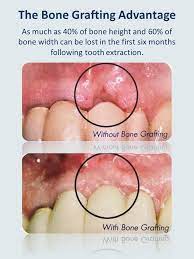 Advantage Of Bone Grafting Dental Dentalhealth Bonegrafting Teeth Sandhillsoms Bone Grafting Dental Dental Implants
