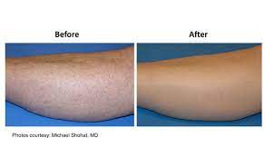 Laser hair removal is effective in treating this disorder by temporarily or permanently removing the hair from the chronically inflamed lesion. Laser Hair Removal Foothills Center North Wilkesboro Nc