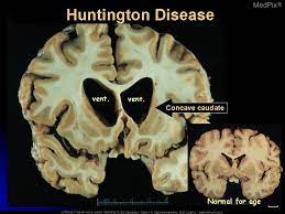 Medpix Case Huntington Chorea