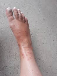 Image result for flea bites
