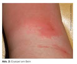 Image result for erysipel photos)