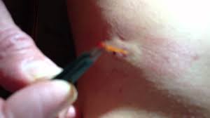 Removing needles from your body. Barrel Cactus Needle Extreme Projectile Extraction Youtube