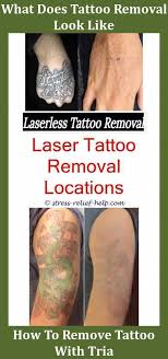 See reviews, photos, directions, phone numbers and more for the best tattoo removal in colorado springs, co. Laser Tattoo Removal Near Me Laser Eyebrow Tattoo Removal Before And After How Much Tattoo Removal Laser Tattooentfernung Tatowierte Augenbrauen Tatowierungen