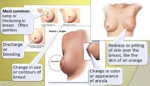 Breast cancer is cancer that develops from breast tissue. 8 Signs And Symptoms Of Breast Cancer 9 Download Scientific Diagram