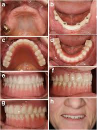 Novel expandable short dental implants in situations with reduced vertical  bone height—technical note and first results