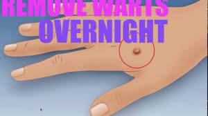 Replace it after every shower or whenever it loses its stick. How To Get Rid Of A Wart Overnight Youtube