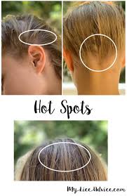 Loaded With Pictures Discover The Different Colors Of Lice Eggs And How You Can Determine The Difference Between Live And Dead Nits In 2020 Lice Eggs Louse Hair Lice