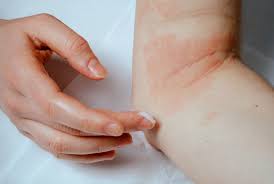 Nov 05, 2019 · eine neurodermitis (atopisches ekzem, atopische dermatitis) verläuft bei jedem betroffenen anders. Neurodermitis Ursachen Behandlung Symptome Geo