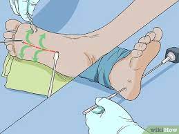 3 Ways To Get Rid Of Heel Spurs - Wikihow