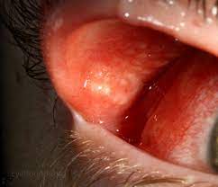 Parinaud Oculoglandular Syndrome