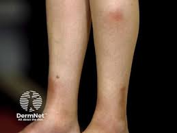 Image result for erythema nodosum