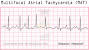 Wandering Atrial Pacemaker Ecg