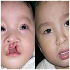 After cleft lip surgery there will be sutures (stitches) in your child's lip. Cleft Lip And Palate Surgery Partners In Plastic Surgery
