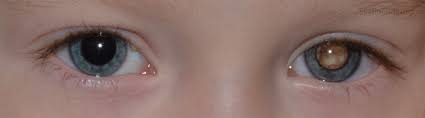 You also may notice a new dark spot in one eye. Retinoblastoma A Childhood Eye Cancer