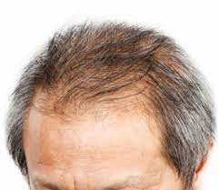 Prostaglandin d2 specifically has been implicated in male pattern hair loss (and hair loss generally). Hair Loss From Mold In The Home