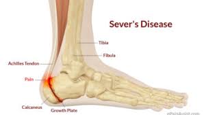 Stress fractures tend to occur in runners' pelvic areas, legs or feet. Stress Fracture Foot Pain Stress Fracture Foot Symptoms Podogo