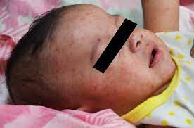 Sama seperti vaksin campak, imunisasi campak jenis mr ini juga diberikan bayi usia 5 bulan dan sama seperti vaksin suntik lainnya, imunisasi campak juga kerap berefek pada demam ringan, ruam. Peningkatan Kes Measles Demam Campak Di Malaysia Status Sehingga 26 Jun 2016 From The Desk Of The Director General Of Health Malaysia
