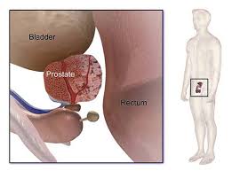 prostate cancer occurs in the prostate gland, which is located just below the bladder in males and surrounds the top portion of the tube that drains urine from the bladder (urethra). Experienced Prostate Cancer Specialists In Singapore Tan Urology