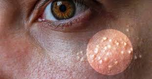 This 7 Remedies Can Remove The Milia Milk Spots From Your Face Ladies Heath Mag Small Bumps On Forehead Forehead Acne Pimples On Forehead