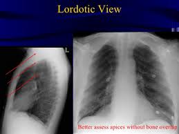 Maybe you would like to learn more about one of these? Lordotic View Cxr Shefalitayal