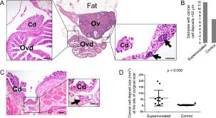 Early symptoms can be regular bloating, abdominal pain or persistent pelvic pain as well as trouble with eating. Inflammation Is A Key Contributor To Ovarian Cancer Cell Seeding Scientific Reports