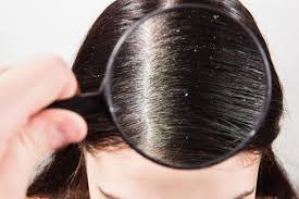 Top 10 Home Remedies That Fights With Dandruff Bella Knows Best In 2020 Dandruff Dandruff Problems Home Remedies For Dandruff