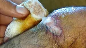 With time the water will loosen things enough that you can pull the gauze off. How To Remove Bandage From Wound Without Pain Youtube