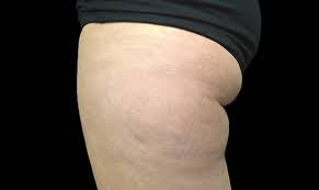 We did not find results for: Coolsculpting Before After Pictures Coolsculpting