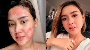 Последние твиты от cita citata (@cita_citata). Wajah Sempat Memerah Ini 6 Potret Perjuangan Cita Citata Lawan Sakit Amandel Hot Liputan6 Com