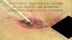 Maybe you would like to learn more about one of these? Granulation Tissue Treatment Youtube