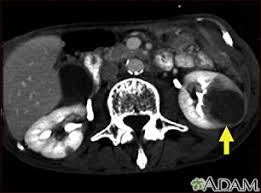 Kidney tumor with suspicion of spread. Kidney Metastases Ct Scan Medlineplus Medical Encyclopedia Image