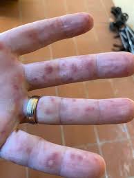 7) «coxsackievirus a6 associated hand, foot and mouth disease in adults: Perth Doctor Warns Of Upsurge In Highly Contagious Hand Foot And Mouth Disease The West Australian