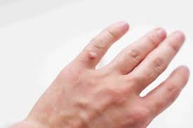 الثواليل Warts بن سينا مقالات طبية موثوقة