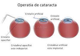Maybe you would like to learn more about one of these? Cataracta Si Implantul De Cristalin