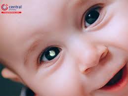 U nguyên bào võng mạc: nguyên nhân, triệu chứng và điều trị bệnh