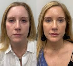 Goals 🤩 The power of filler 👏🏼 We love the results filler can deliver 😍  Talk about restoring volume and softening lines to give a refreshed,  natural result! ✨ This beautiful patient's