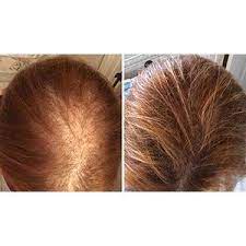 Before And After Hair Growth System Hair Laser Growth Hair Loss Men